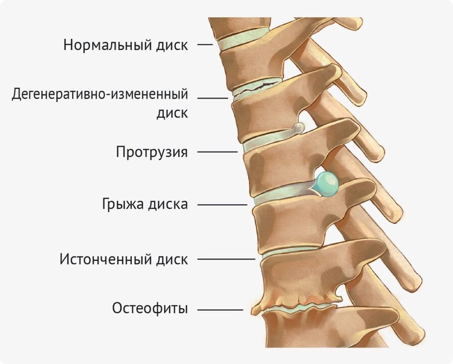 Disc deformations for lumbar osteochondrosis