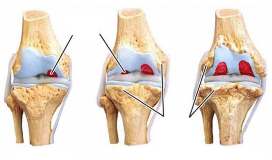 degree-arthrosis