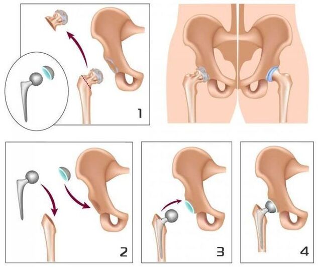 Replace a painful seal with a prosthesis