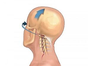 How osteochondrosis of the cervical column manifests itself
