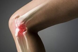 Osteoarthritis of the knee joint is a lesion of cartilage tissue