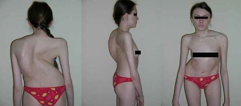 curvature of the spine due to osteochondrosis