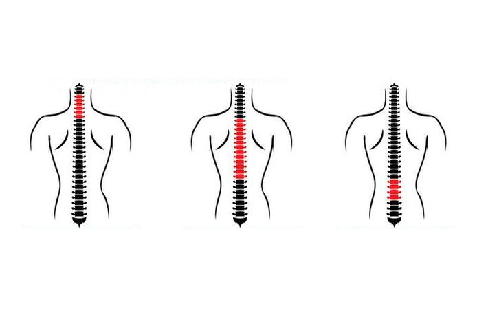 How does osteochondrosis manifest