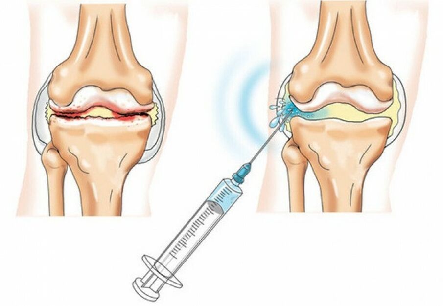 injection into the knee joint with arthrosis