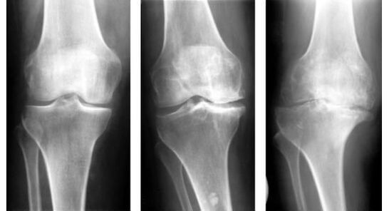 A mandatory diagnostic measure when identifying osteoarthritis of the knee is an x-ray