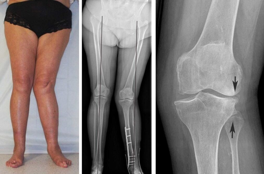 Advanced osteoarthritis of the knee joints is clearly visible visually even without an x-ray