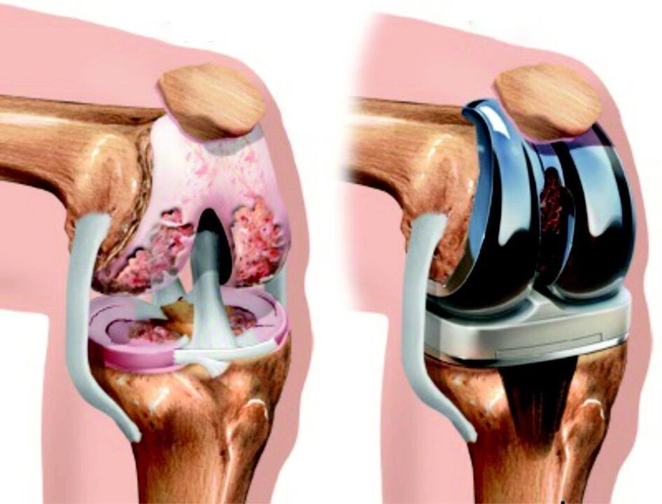 In the event of total damage to the knee joint due to osteoarthritis, it can be restored with endoprostheses. 